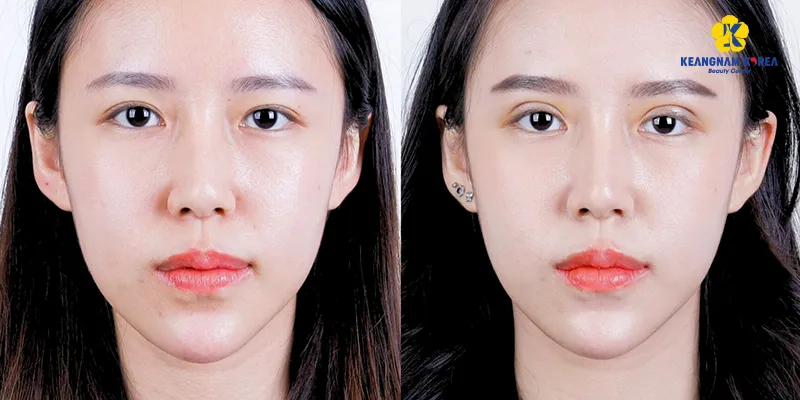 Bắn plasma mắt là gì? 4 bắn plasma mắt