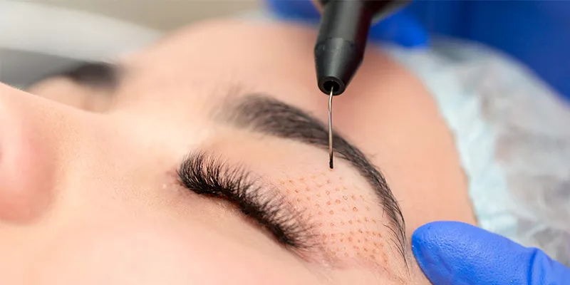 bắn plasma mí mắt