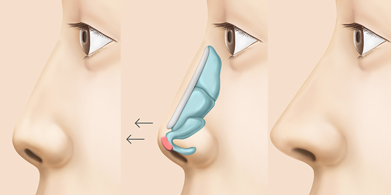 Bọc cân cơ đầu mũi là gì? Ưu nhược điểm nên biết trước khi thực hiện 3 Bọc cân cơ đầu mũi