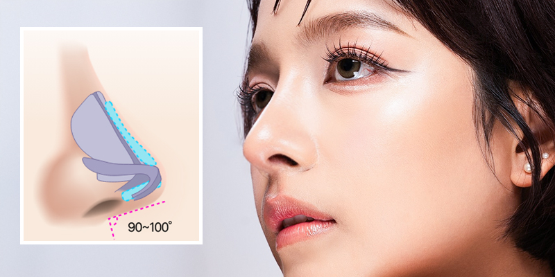 Bọc cân cơ đầu mũi là gì? Ưu nhược điểm nên biết trước khi thực hiện 2 Bọc cân cơ đầu mũi