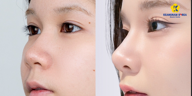 Bọc cân cơ đầu mũi là gì? Ưu nhược điểm nên biết trước khi thực hiện 4 Bọc cân cơ đầu mũi