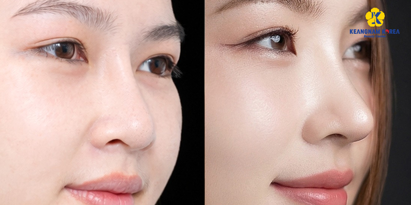 Bọc cân cơ đầu mũi là gì? Ưu nhược điểm nên biết trước khi thực hiện 5 Bọc cân cơ đầu mũi