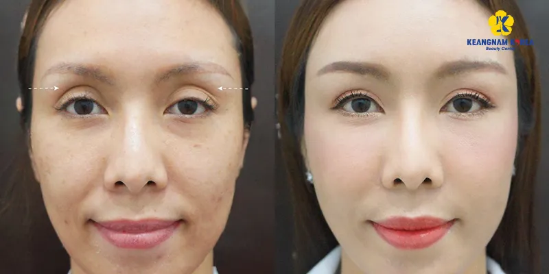 Cách chăm sóc sau cấy mỡ hốc mắt an toàn, chuẩn y khoa và các lưu ý để tránh “xôi hỏng bỏng không” 2 chăm sóc sau cấy mỡ hốc mắt