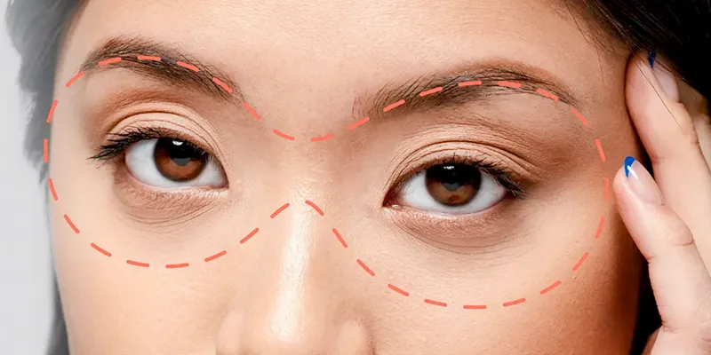 chăm sóc sau cấy mỡ hốc mắt