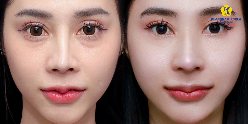 Đâu là các cách khắc phục mũi lệch sau khi nâng? 5 cach khac phuc mui lech 4