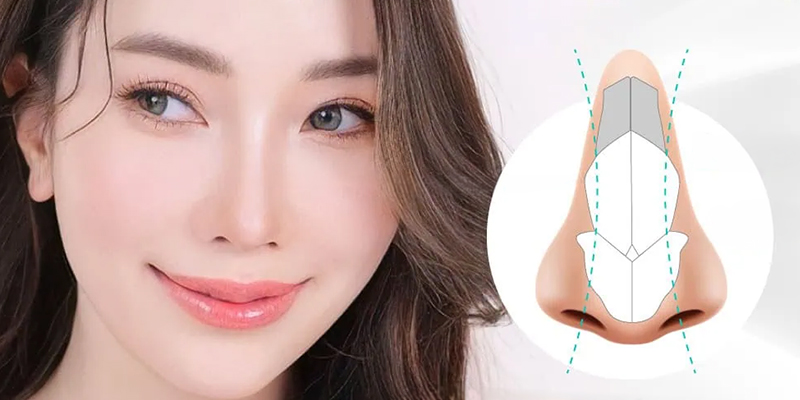 Đâu là các cách khắc phục mũi lệch sau khi nâng? 1 cách khắc phục mũi lệch