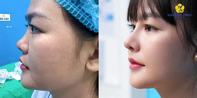 Điểm tên các cách làm mũi thon và cao tại nhà cùng những lưu ý để tránh làm mũi to ra 5 cách làm mũi thon và cao