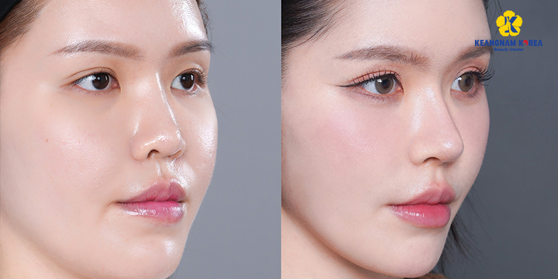 Cách nhận biết mũi cao ở nam và nữ 4 Cách nhận biết mũi cao