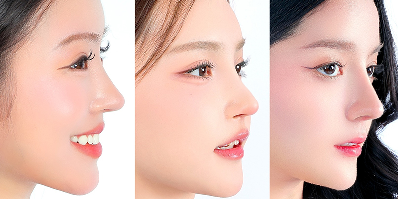Đâu là các cách khắc phục mũi lệch sau khi nâng? 4 cách khắc phục mũi lệch