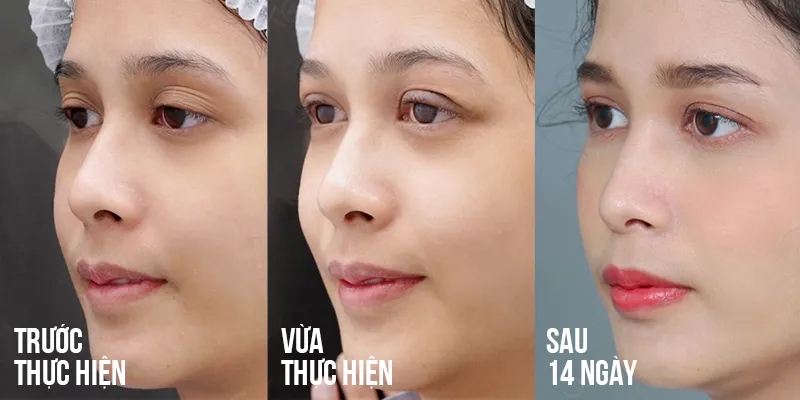 Cách chăm sóc sau cấy mỡ hốc mắt an toàn, chuẩn y khoa và các lưu ý để tránh “xôi hỏng bỏng không” 3 chăm sóc sau cấy mỡ hốc mắt