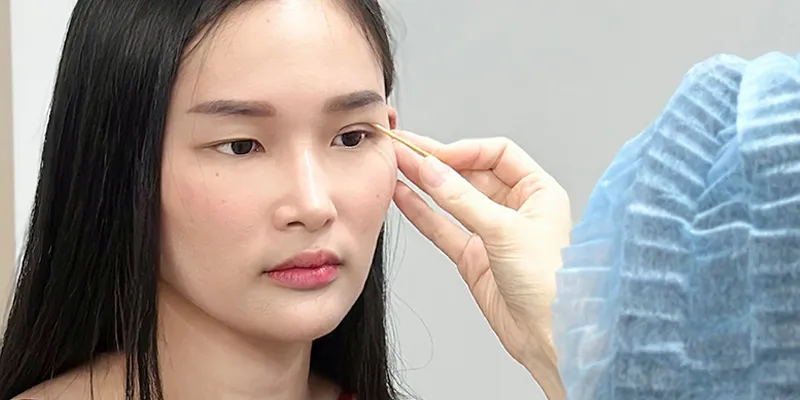 Có nên cắt da thừa mí mắt không? 2 có nên cắt da thừa mí mắt không