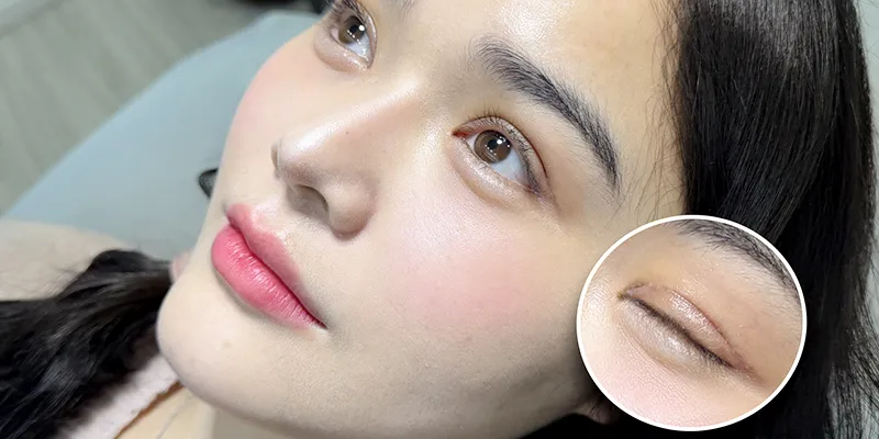 Có nên cắt da thừa mí mắt không? 6 có nên cắt da thừa mí mắt không