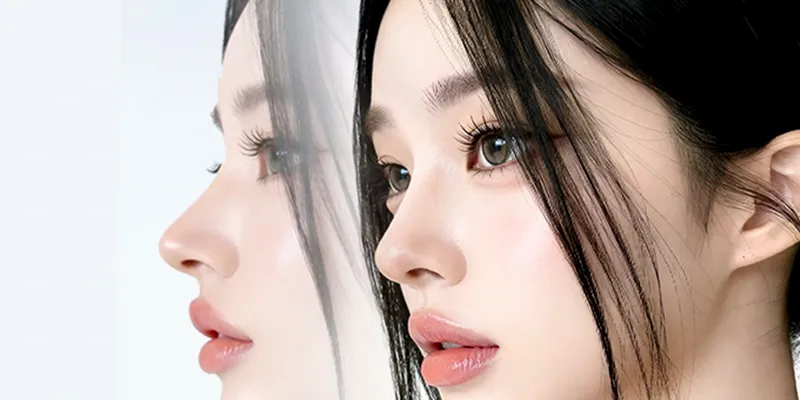 các kiểu nâng mũi