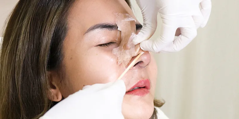 Các dấu hiệu mũi bị viêm sau nâng, cần xử lý ngay trước khi quá trễ 5 Dấu hiệu mũi bị viêm sau nâng