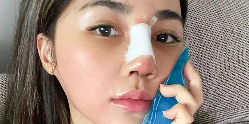 Các dấu hiệu mũi bị viêm sau nâng, cần xử lý ngay trước khi quá trễ 1 Dấu hiệu mũi bị viêm sau nâng