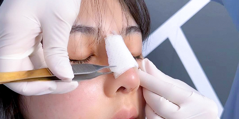 Dấu hiệu nâng mũi không hợp sụn: Nhận biết sớm để tránh biến chứng nguy hiểm 5 dấu hiệu nâng mũi không hợp sụn