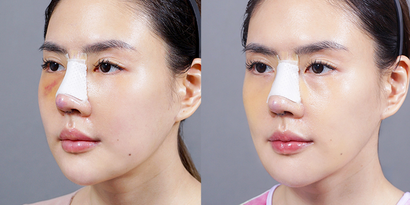 Dấu hiệu nâng mũi không hợp sụn: Nhận biết sớm để tránh biến chứng nguy hiểm 4 dấu hiệu nâng mũi không hợp sụn