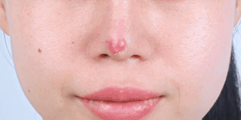 Dấu hiệu nâng mũi không hợp sụn: Nhận biết sớm để tránh biến chứng nguy hiểm 1 dấu hiệu nâng mũi không hợp sụn