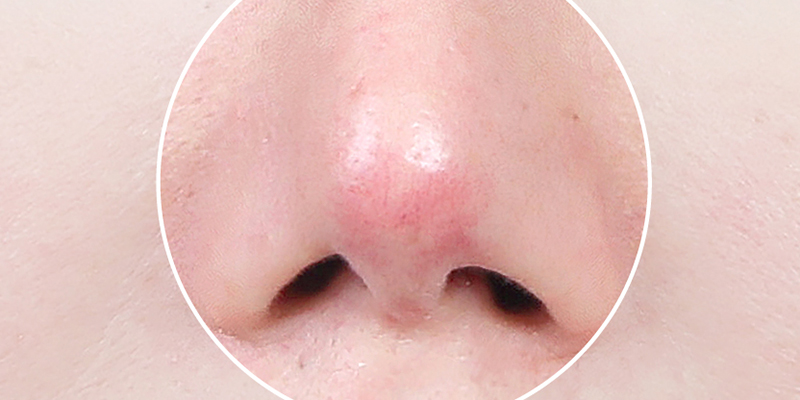 Dấu hiệu nâng mũi không hợp sụn: Nhận biết sớm để tránh biến chứng nguy hiểm 2 dấu hiệu mũi không hợp sụn