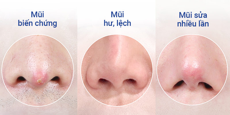 Đâu là các cách khắc phục mũi lệch sau khi nâng? 7 cách nhận biết mũi bị lệch