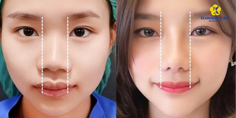 Có nên thu gọn cánh mũi không? Review chi tiết và bảng giá 2026 2 hình ảnh trước và sau thu gọn cánh mũi