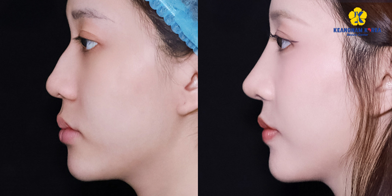 Miếng bọc đầu mũi là gì? 4 Miếng bọc đầu mũi là gì?