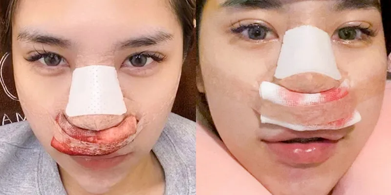 Các dấu hiệu mũi bị viêm sau nâng, cần xử lý ngay trước khi quá trễ 3 Dấu hiệu mũi bị viêm sau nâng