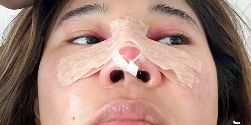 Các dấu hiệu mũi bị viêm sau nâng, cần xử lý ngay trước khi quá trễ 2 Dấu hiệu mũi bị viêm sau nâng