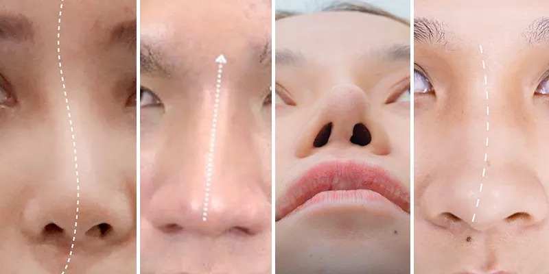 Nâng mũi bị lệch vách ngăn do đâu? Có nguy hiểm không? Khắc phục như thế nào? Sửa ở đâu tốt? 2 nâng mũi bị lệch vách ngăn