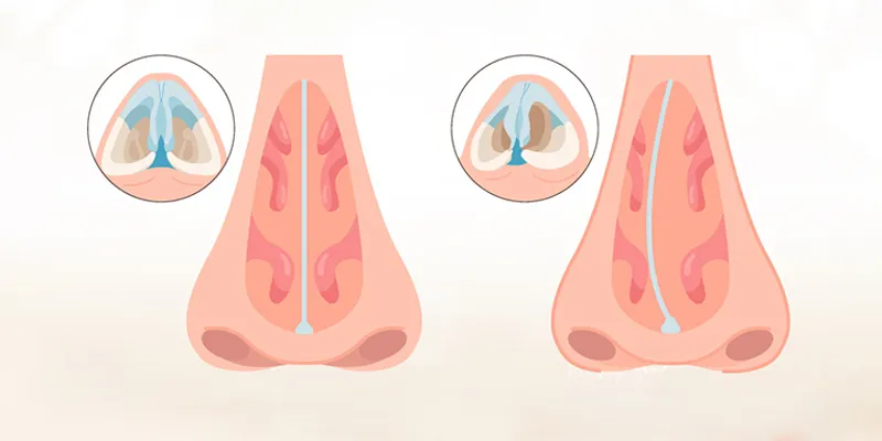 Nâng mũi bị lệch vách ngăn do đâu? Có nguy hiểm không? Khắc phục như thế nào? Sửa ở đâu tốt? 3 nâng mũi bị lệch vách ngăn