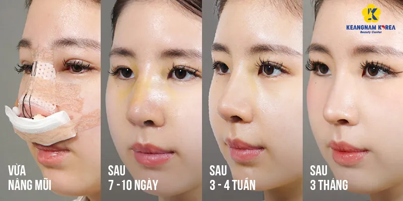 Nâng mũi sau 1 tháng bị sưng là bình thường hay dấu hiệu bất thường? 2 nâng mũi sau 1 tháng bị sưng