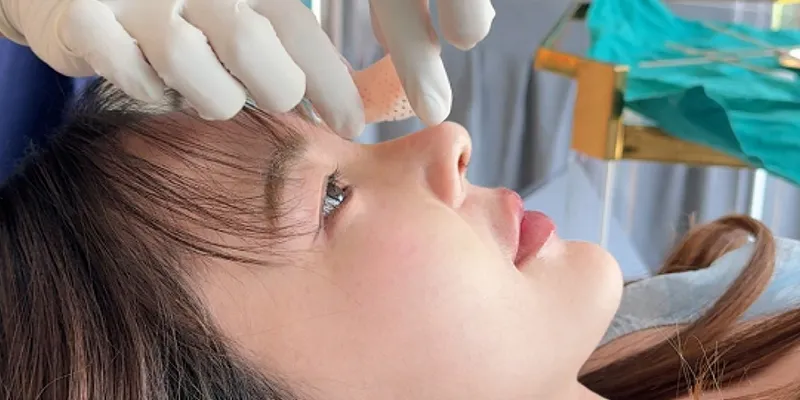 Nâng mũi sau 1 tháng bị sưng là bình thường hay dấu hiệu bất thường? 3 nâng mũi sau 1 tháng bị sưng