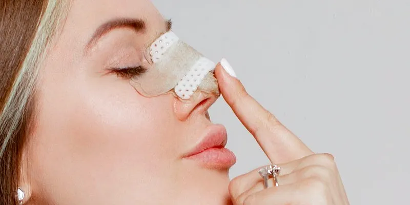 Nâng mũi sau 1 tháng bị sưng là bình thường hay dấu hiệu bất thường? 1 nâng mũi sau 1 tháng bị sưng