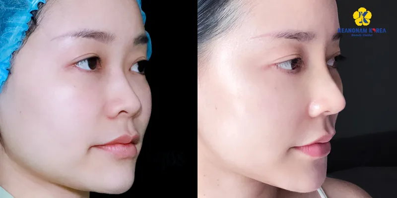 Có những loại nâng mũi nào? Tổng hợp các phương pháp thẩm mỹ mũi thịnh hành nhất 3 Nâng mũi sụn sinh học