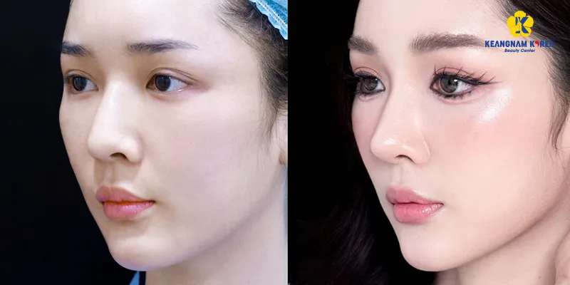 Có những loại nâng mũi nào? Tổng hợp các phương pháp thẩm mỹ mũi thịnh hành nhất 5 Nâng mũi sụn tự thân