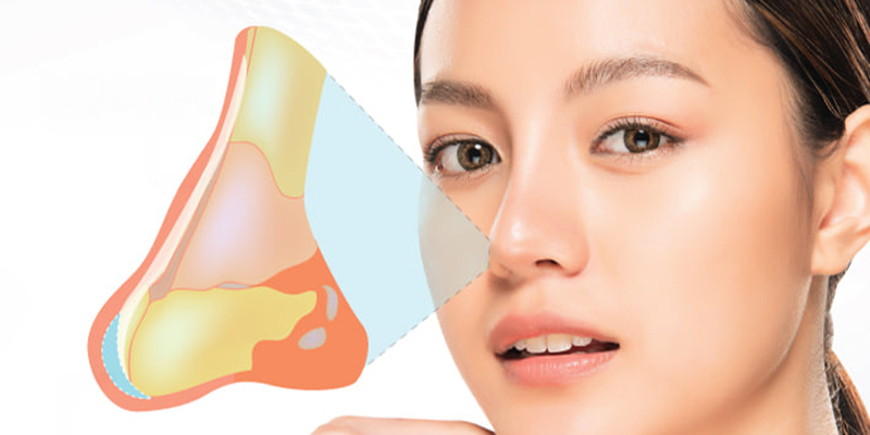 Nâng mũi xong tháo ra có được không? Tháo mũi đã nâng có đau không? 2 nâng mũi xong tháo ra có được không