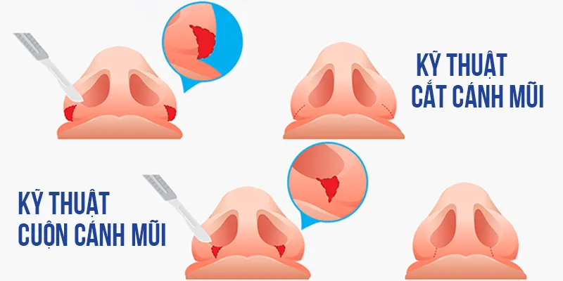 Phân biệt cuộn cánh mũi và cắt cánh mũi: Phương pháp nào phù hợp với bạn? 3 Nên cuộn cánh mũi hay cắt cánh mũi