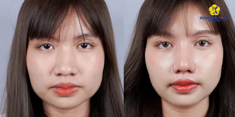 Phân biệt cuộn cánh mũi và cắt cánh mũi: Phương pháp nào phù hợp với bạn? 5 nên cuộn cánh mũi và cắt cánh mũi