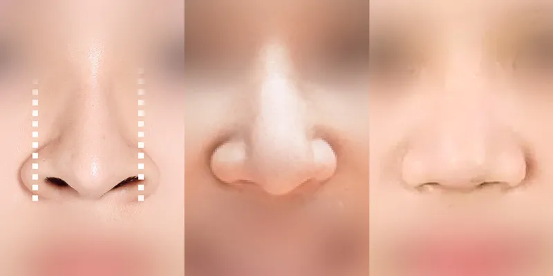 Các phương án phẫu thuật mũi to thành nhỏ, đạt được dáng mũi thanh tú tự nhiên 2 phau thuat mui to thanh nho 1