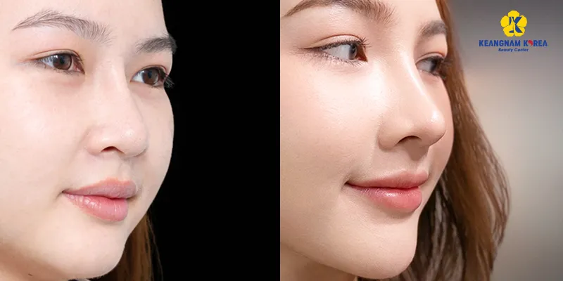 Các phương án phẫu thuật mũi to thành nhỏ, đạt được dáng mũi thanh tú tự nhiên 5 Hình ảnh trước và sau khi thu gọn cánh mũi