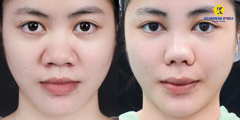 Các phương án phẫu thuật mũi to thành nhỏ, đạt được dáng mũi thanh tú tự nhiên 3 Các phương án phẫu thuật mũi to thành nhỏ, đạt được dáng mũi thanh tú tự nhiên