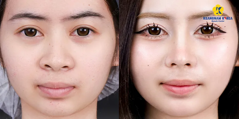 Các phương án phẫu thuật mũi to thành nhỏ, đạt được dáng mũi thanh tú tự nhiên 4 phau thuat mui to thanh nho 4