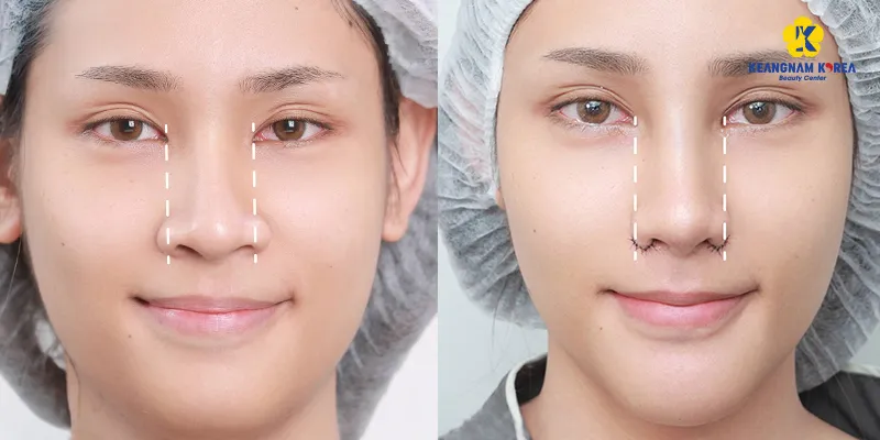 Phẫu thuật thu nhỏ cánh mũi ở đâu tốt? Top 5 cơ sở phẫu thuật thu gọn cánh mũi uy tín tại Sài Gòn 2 trước và sau khi phẫu thuật thu nhỏ cánh mũi
