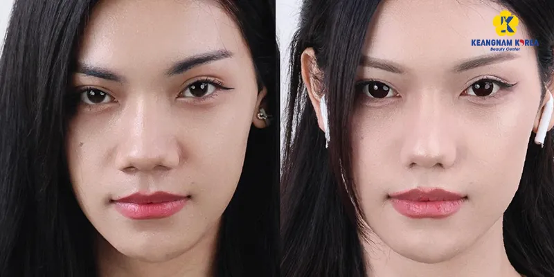 Phẫu thuật thu nhỏ lỗ mũi giá bao nhiêu? Ưu nhược điểm là gì? Thực hiện ở đâu tốt? 3 phẫu thuật thu nhỏ lỗ mũi