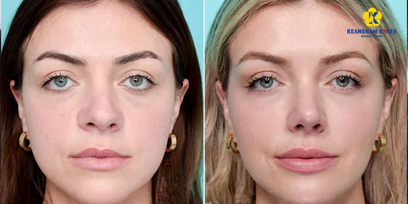 Phẫu thuật thu nhỏ lỗ mũi giá bao nhiêu? Ưu nhược điểm là gì? Thực hiện ở đâu tốt? 5 phẫu thuật thu nhỏ lỗ mũi