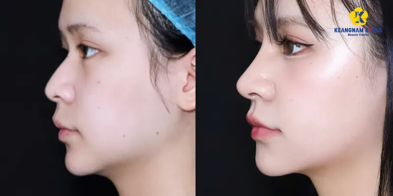 Chi tiết quy trình nâng mũi cấu trúc và bán cấu trúc. Kinh nghiệm "sống còn" khi nâng mũi lần đầu 3 quy trình nâng mũi cấu trúc