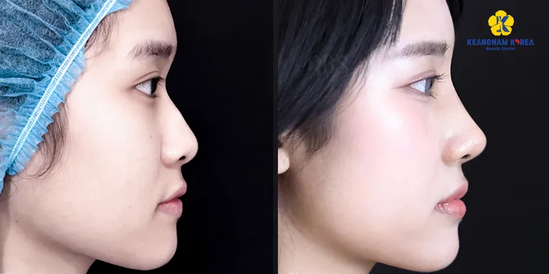 Chi tiết quy trình nâng mũi cấu trúc và bán cấu trúc. Kinh nghiệm "sống còn" khi nâng mũi lần đầu 4 quy trình nâng mũi cấu trúc