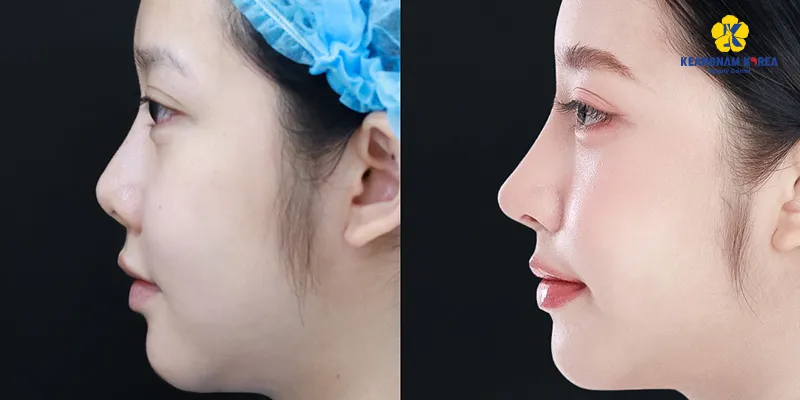 Chi tiết quy trình nâng mũi cấu trúc và bán cấu trúc. Kinh nghiệm "sống còn" khi nâng mũi lần đầu 5 quy trình nâng mũi bán cấu trúc