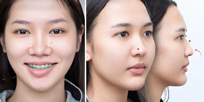 Nên thu gọn cánh mũi hay nâng mũi? 4 so sánh thu gọn cánh mũi và nâng mũi