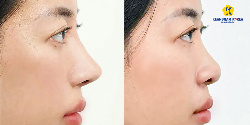 Tháo sụn mũi đã nâng có an toàn không? kinh nghiệm tháo mũi đã nâng không thể không biết 2 Hình ảnh trước và sau khi tháo sụn mũi